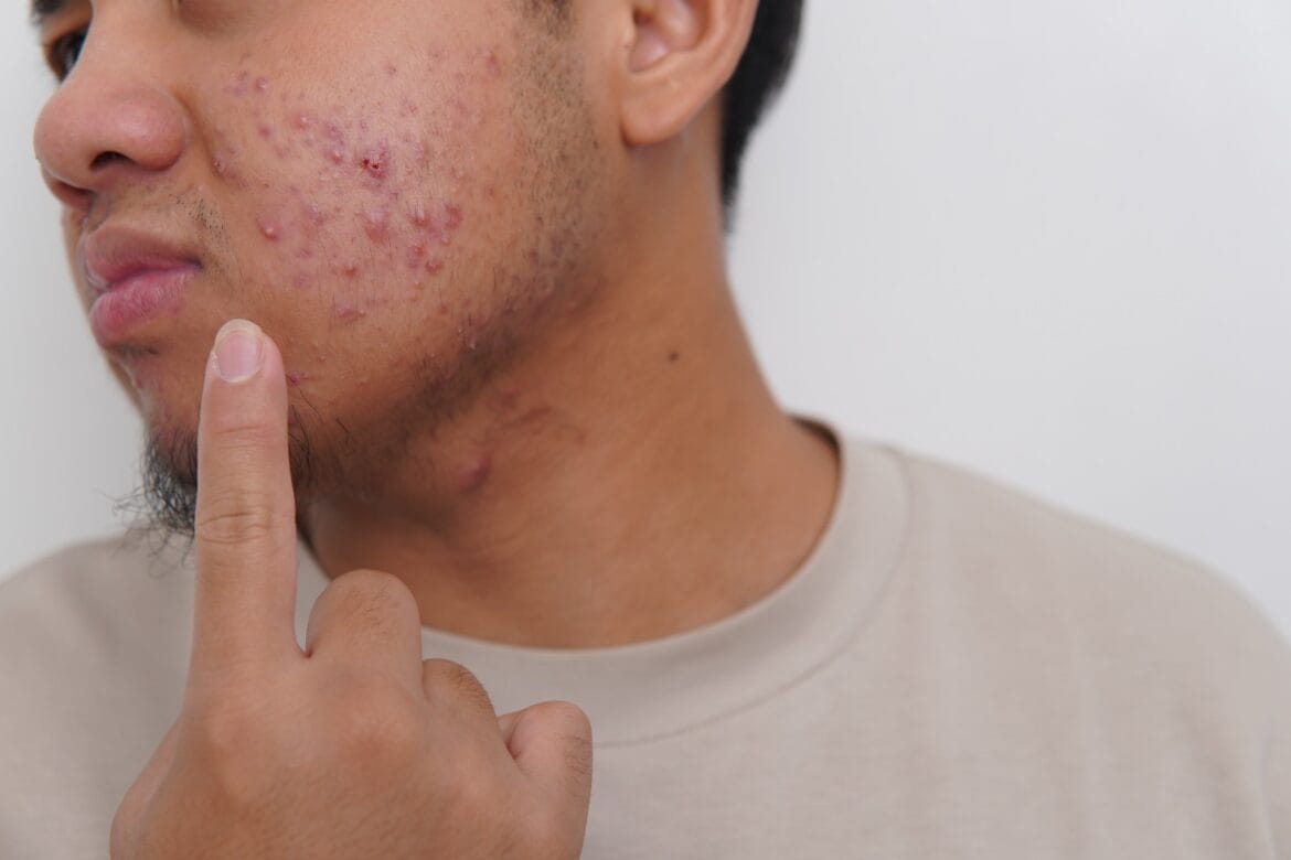 stress dan jerawat