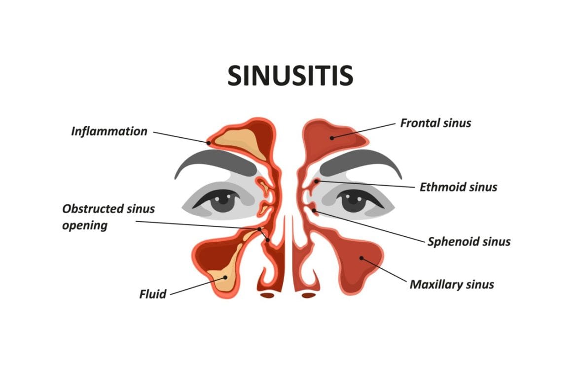 Sakit Kepala Karena Sinus