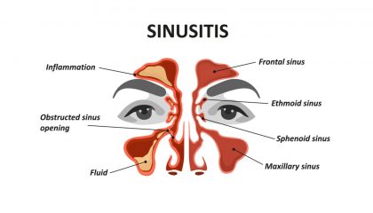Sakit Kepala Karena Sinus