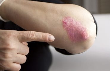 psoriasis adalah