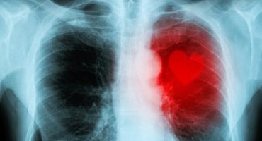 X-ray,Red,Heart,Of,Human,(heart,Disease)