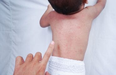 cara mengatasi biang keringat pada bayi