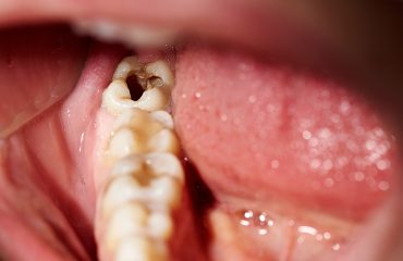 Penyebab Gigi Berlubang dan Perawatannya