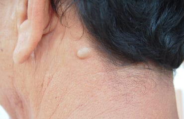 Kista epidermoid adalah