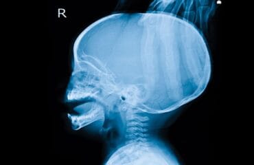 Penyakit hidrosefalus