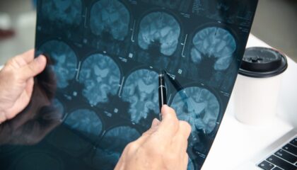 cedera otak traumatik