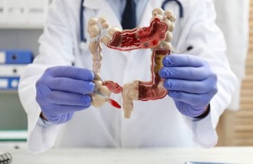 Faktor penyebab kanker usus