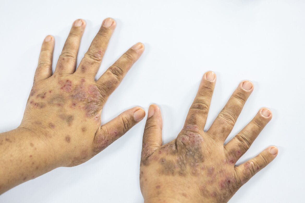 apakah lupus bisa sembuh