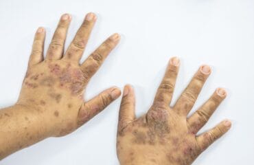 apakah lupus bisa sembuh