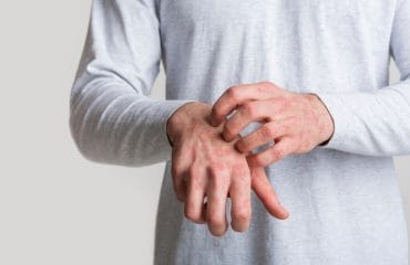 Perbedaan Herpes dan Tomcat