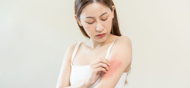 5 Jenis Infeksi Jamur Kulit yang Umum Terjadi dan Pengobatannya