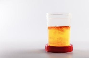 hematuria urine warna merah