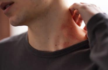 cara menghilangkan kurap dengan cepat