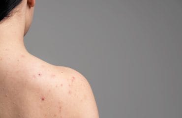 cara menghilangkan jerawat punggung