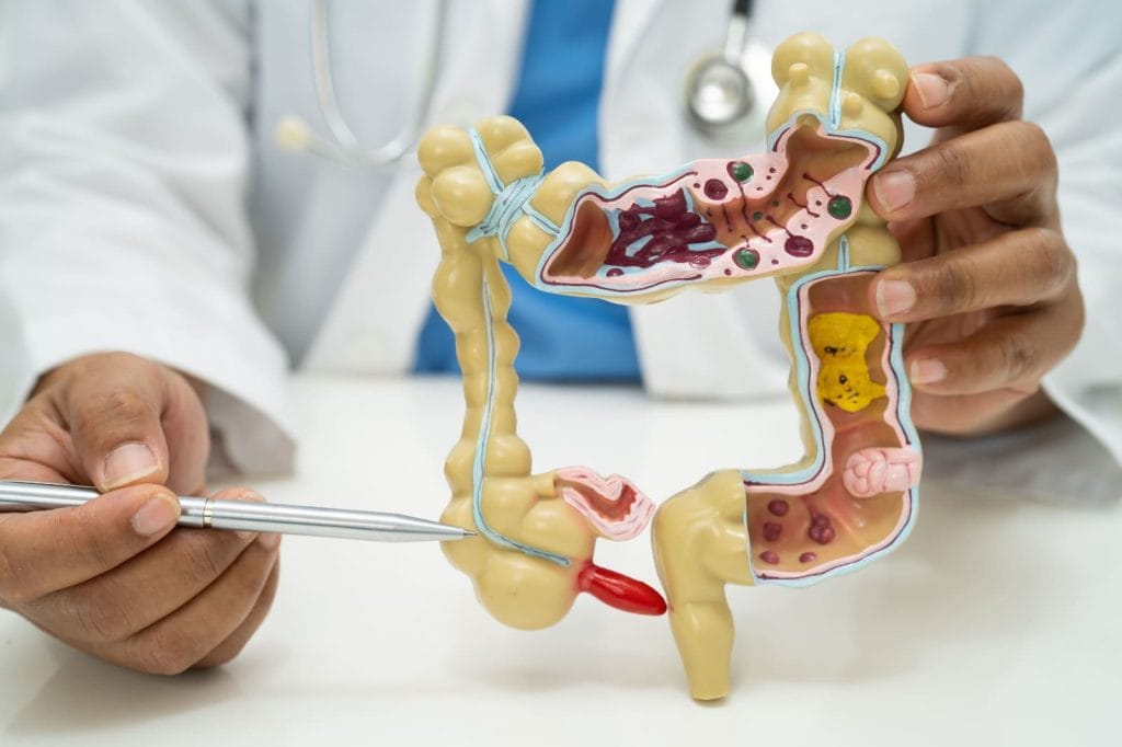 Gejala Radang Usus Buntu