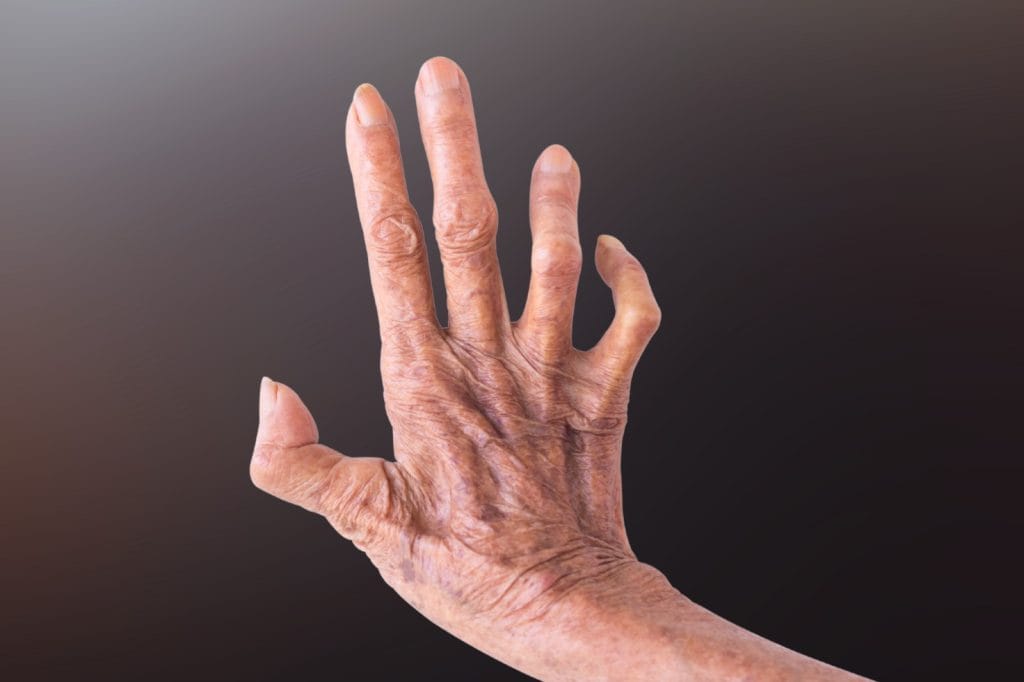 Ciri-ciri penyakit kusta