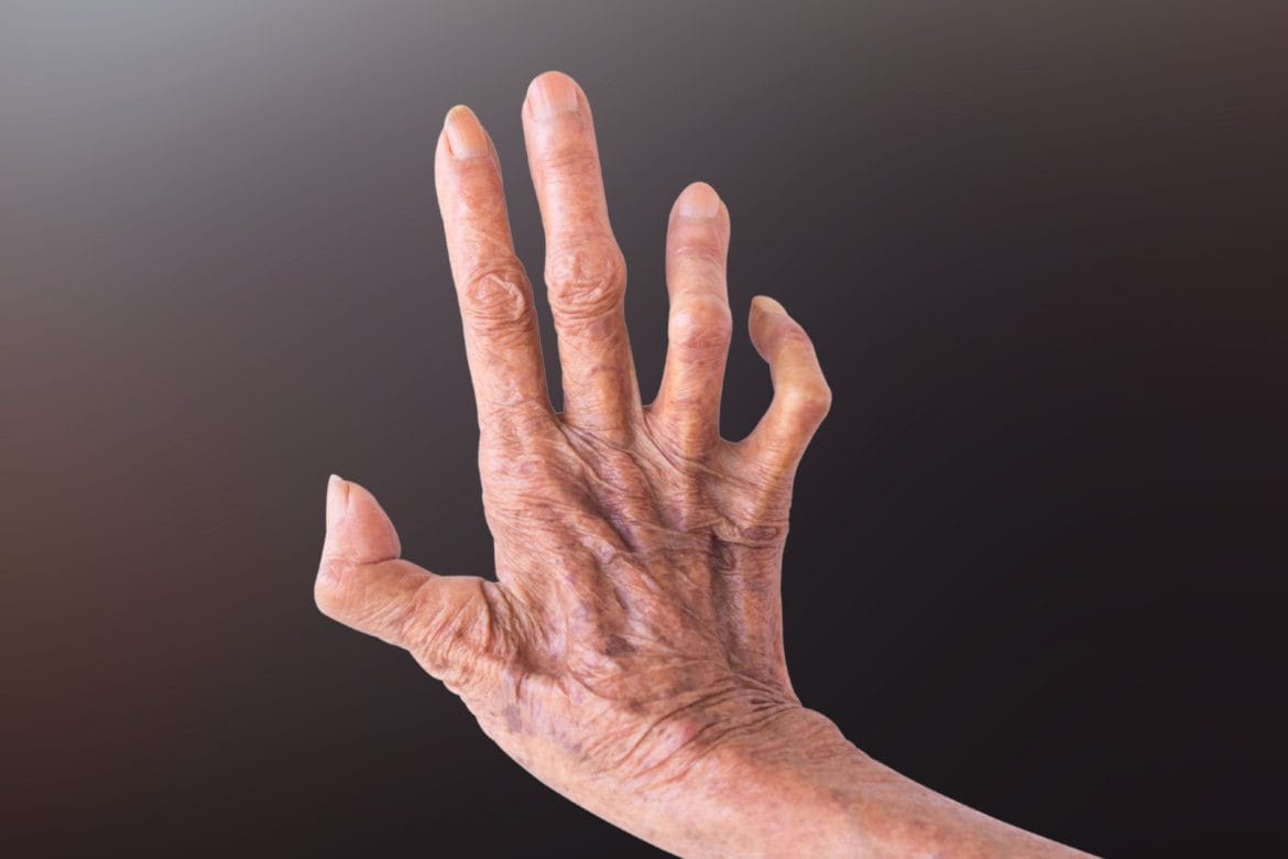 ciri-ciri penyakit kusta