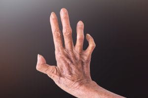 ciri-ciri penyakit kusta