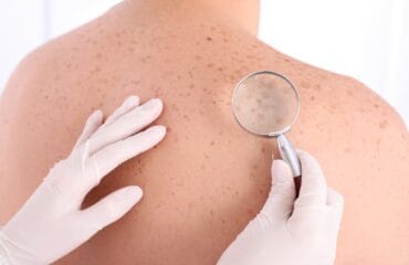 apakah kanker kulit bisa disembuhkan