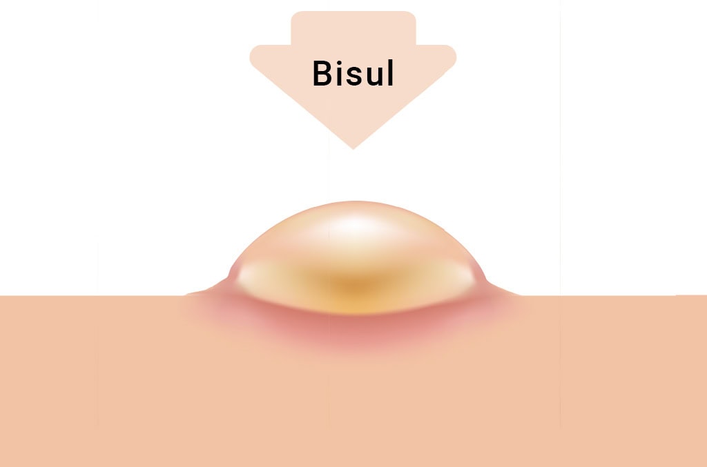 Kompres air hangat sebagai obat bisul alami pertama untuk mempercepat penyembuhan
