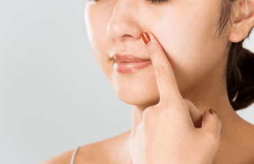 cara menghilangkan komedo secara alami