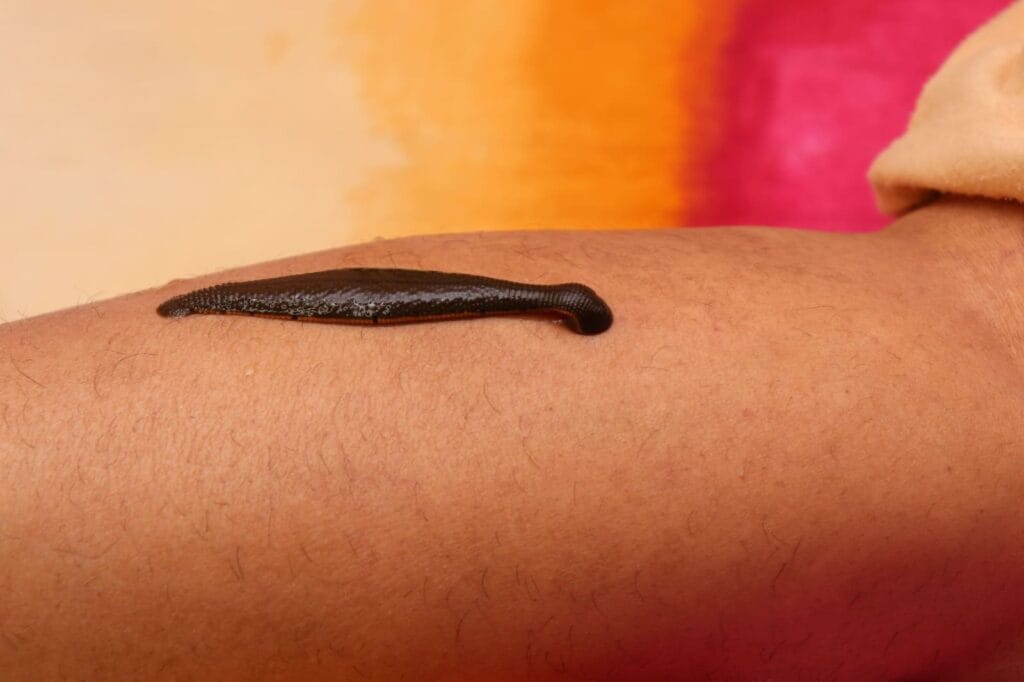 manfaat terapi lintah