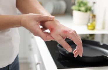 pertolongan pertama luka bakar