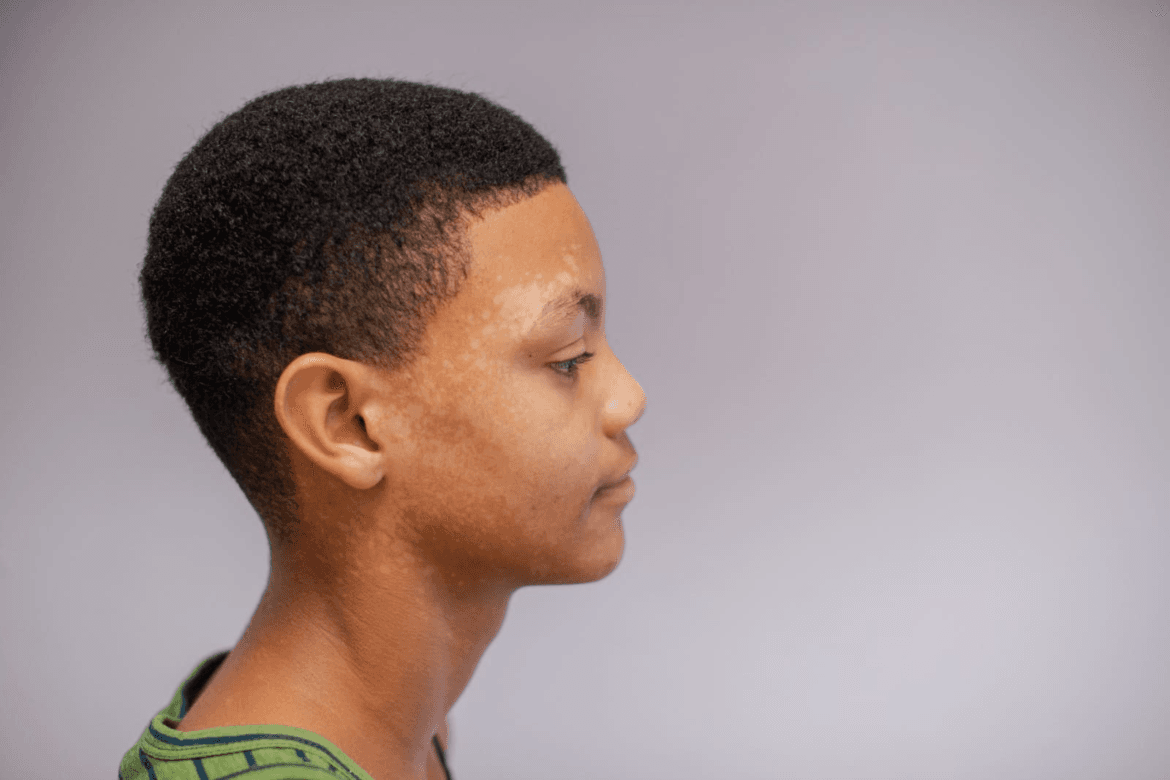 cara menghilangkan panu di wajah