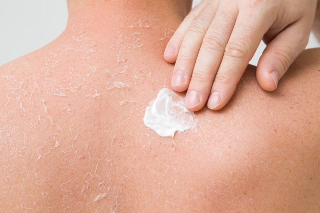 Cara Mengatasi Kulit Kering