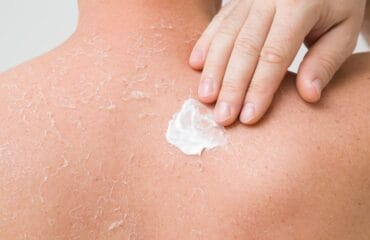 Cara Mengatasi Kulit Kering