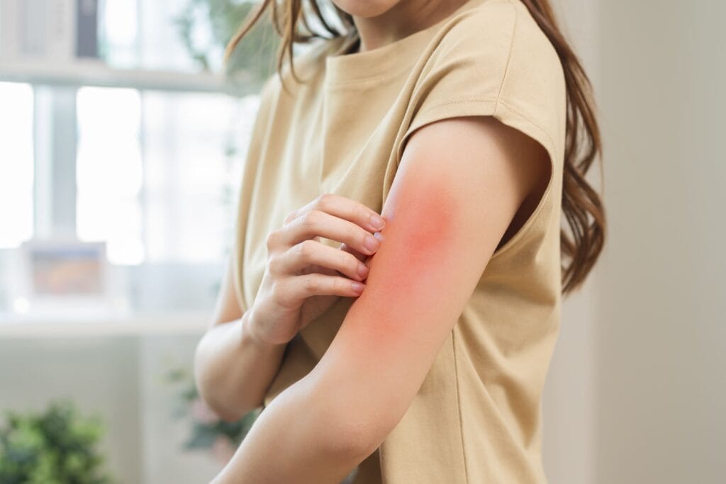 daun untuk obat gatal