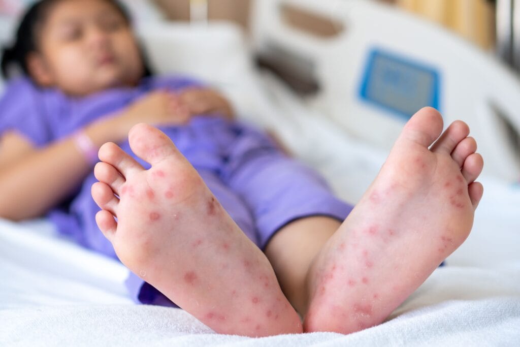 Perbedaan bintik merah DBD dan campak