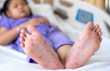 Perbedaan bintik merah DBD dan campak