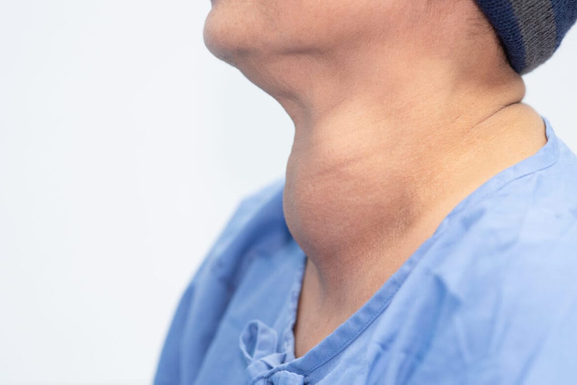 Tanda Tubuh Kelebihan Garam