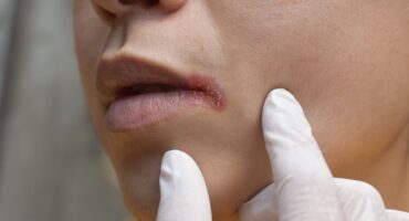 penyakit kanker bibir