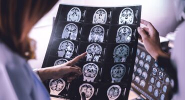 Cerebral atrophy adalah