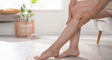 cara menghilangkan varises di kaki