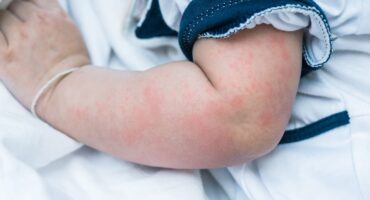 ciri-ciri alergi susu sapi