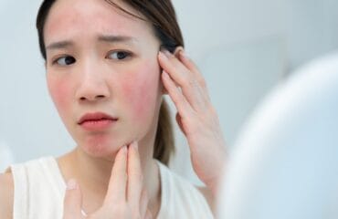 ciri-ciri kulit sensitif