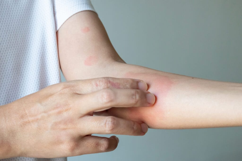 pertolongan pertama alergi