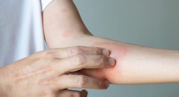 pertolongan pertama alergi