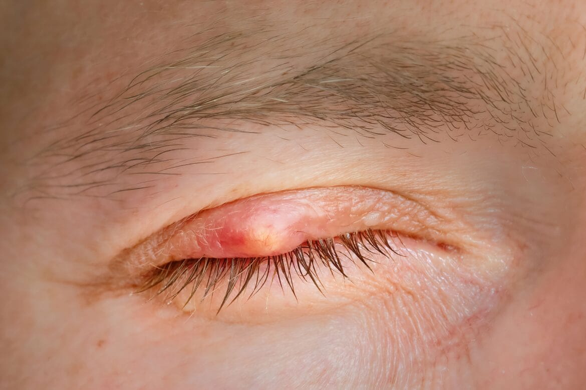 Benjolan di kelopak mata