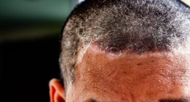 Tinea Capitis adalah