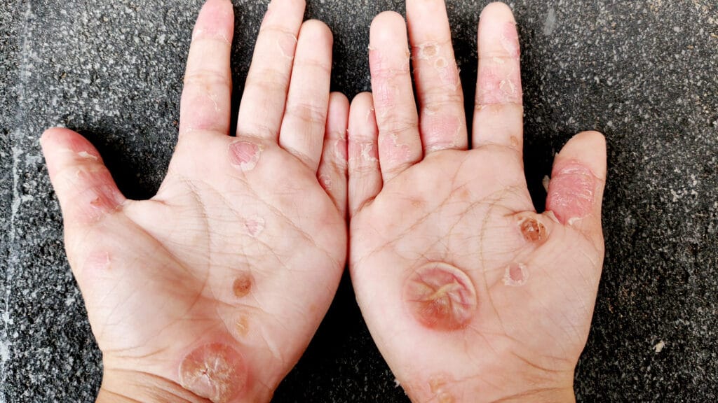 pantangan flu singapura