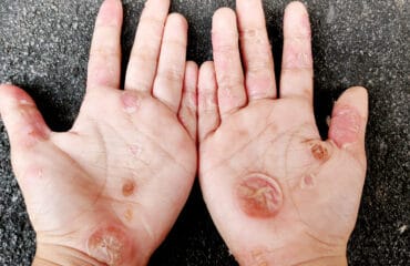 pantangan flu singapura