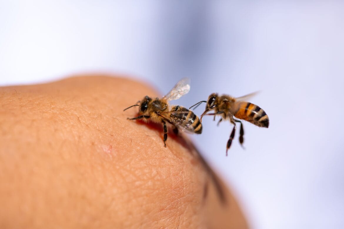 pertolongan pertama disengat lebah