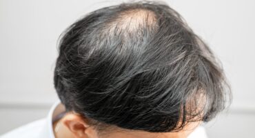 Alopecia Areata